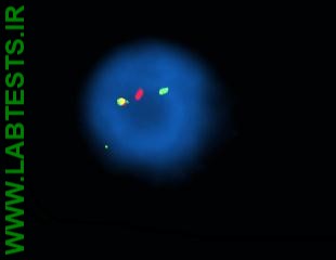 Cell positive for BCR_ABL by FISH