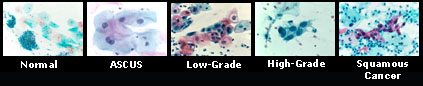 Slides showing possible Pap test results