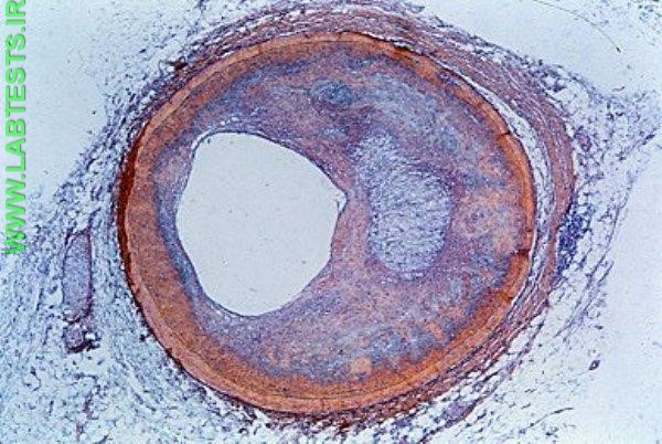 Plaque within an artery