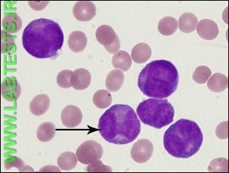 Blood smear from a patient with acute myeloid leukemia (AML)