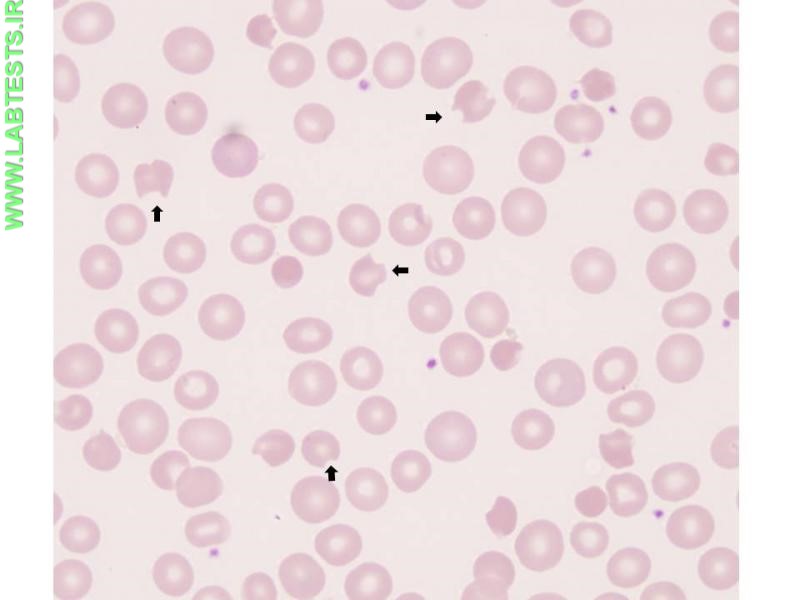 Image of bite cells on a blood smear.