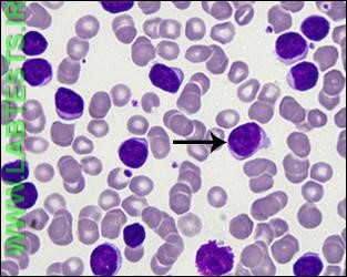 Blood smear from patient with CLL