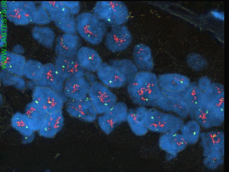 Image of HER2 positive breast tumor cells