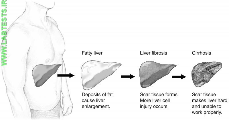 Drawing of liver disease stages
