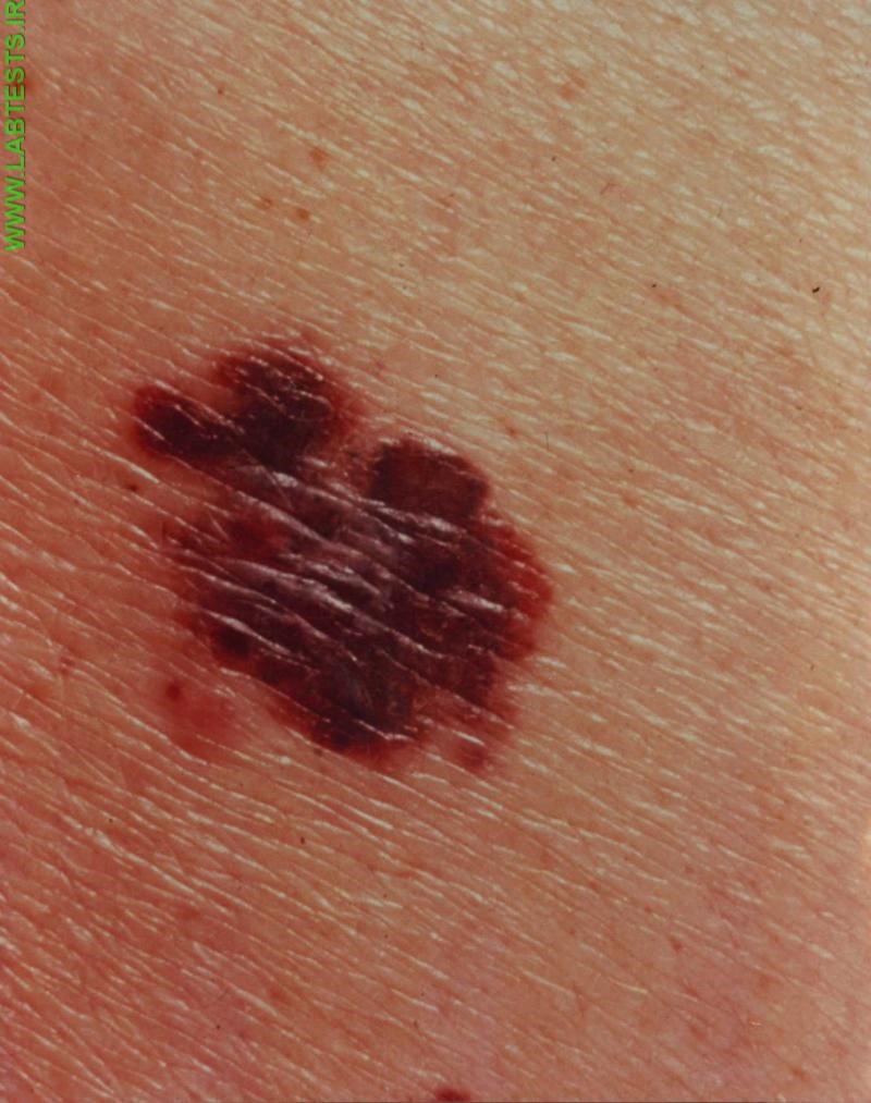 Image of melanoma
