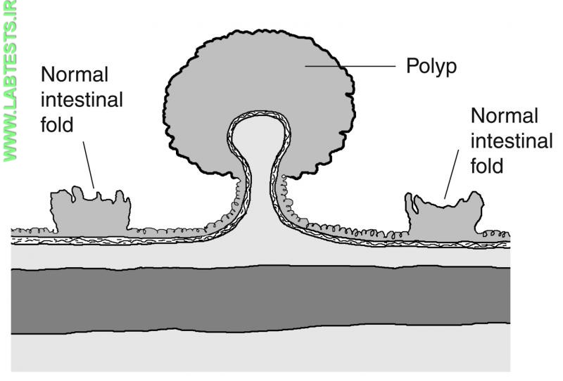 Drawing of a colon polyp