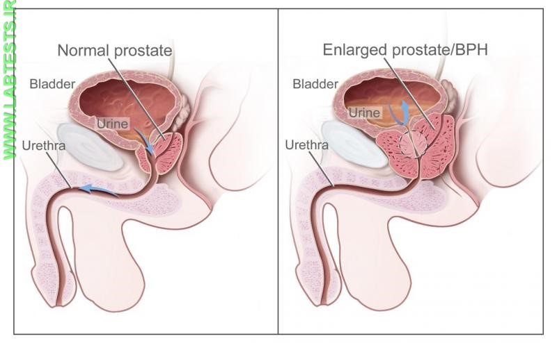 Drawing of an enlarged prostate
