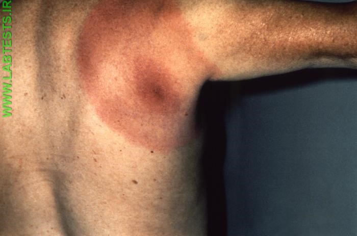 Photo of Lyme disease rash