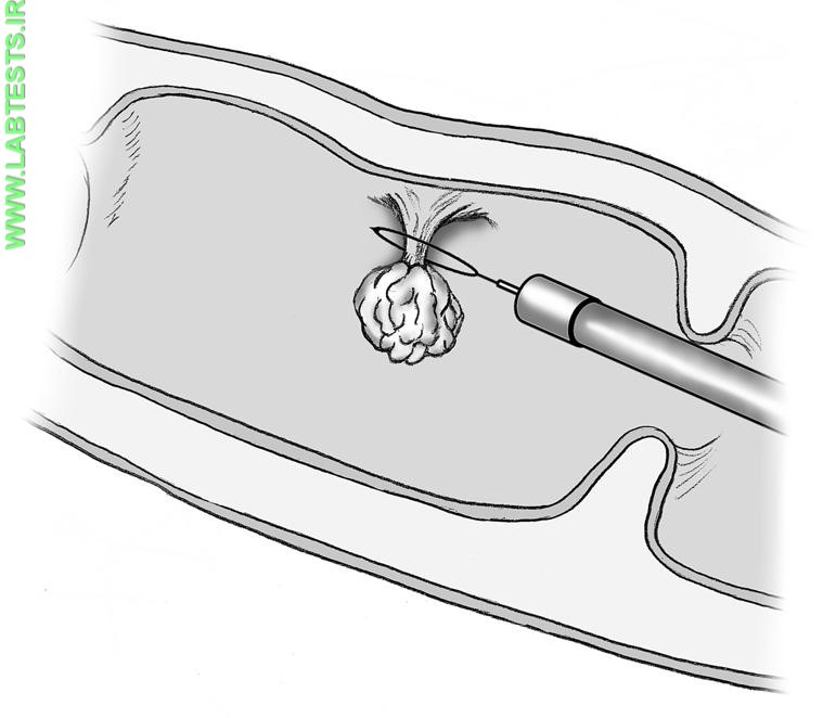 Drawing of polyp removal