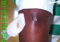 Skin infection