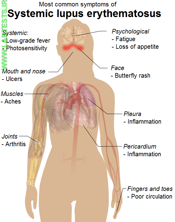 symptoms of Lupus