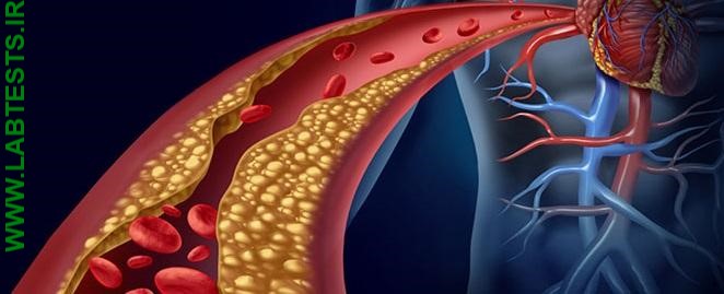 Drawing of plaque in an artery