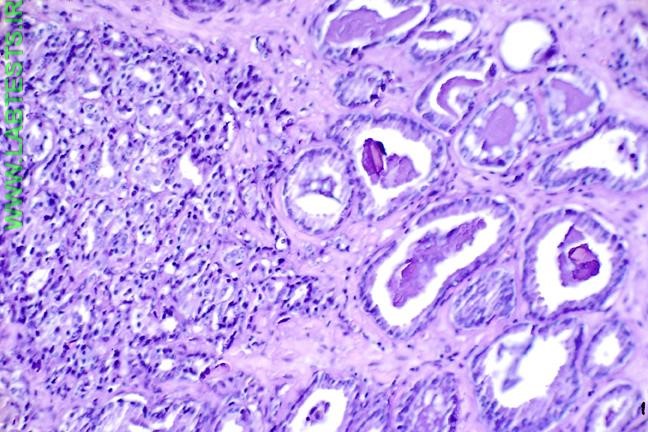 Biopsy (histology) slide showing prostate cancer
