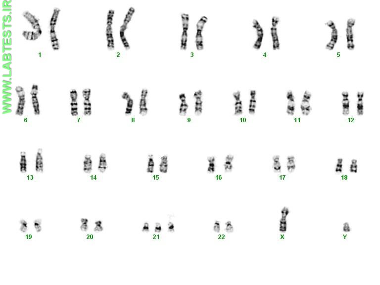 Photo of karyotype with a trisomy 21