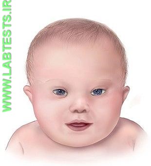Illustration of Baby with Down Syndrome