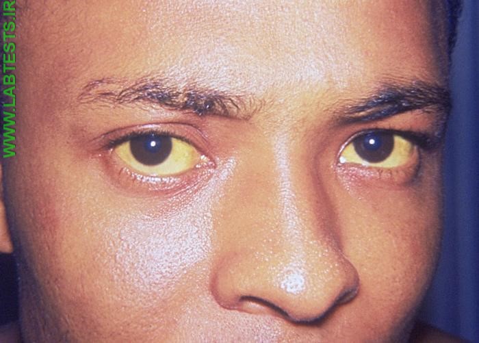 Photo of a man with jaundice
