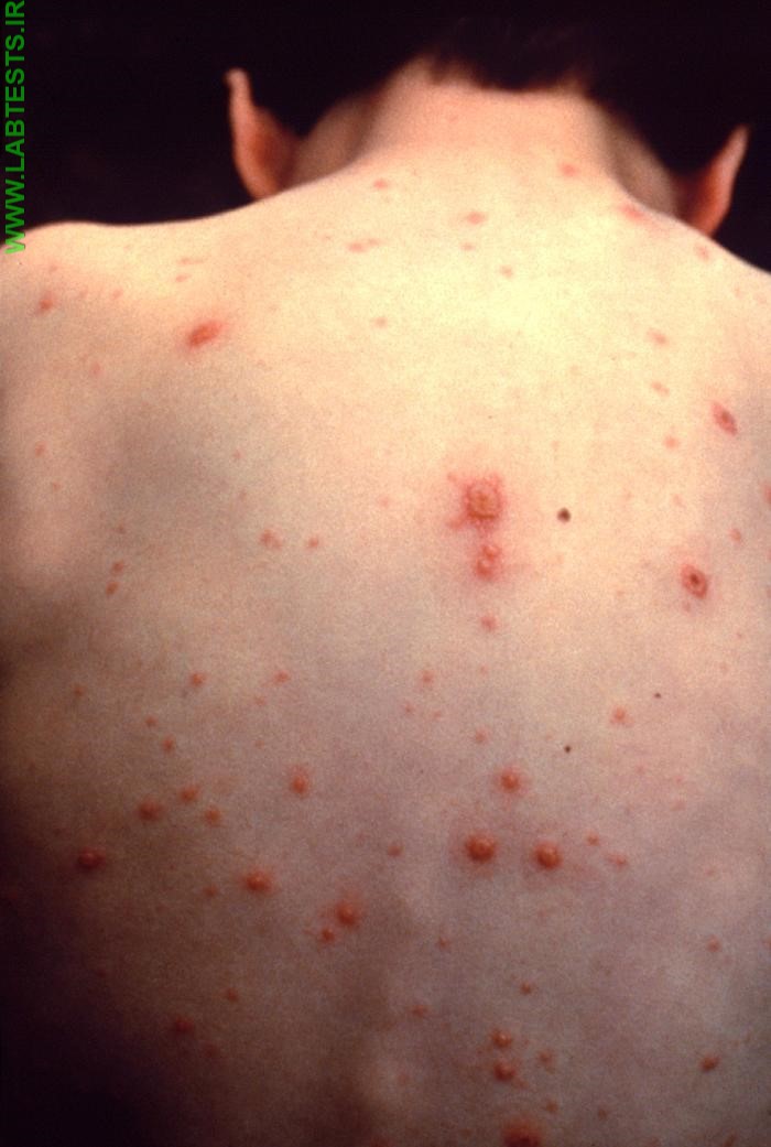 Chicken pox rash