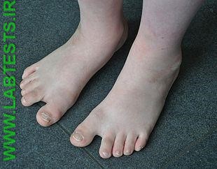 Feet of a child with Downs Syndrome