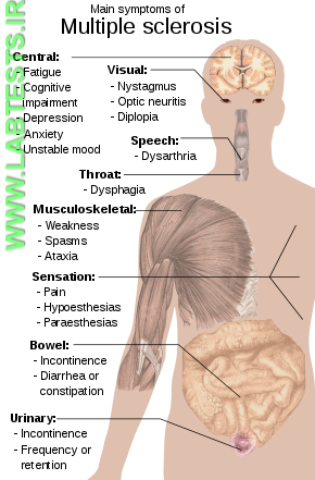 Symptoms of Multiple Sclerosis (MS)