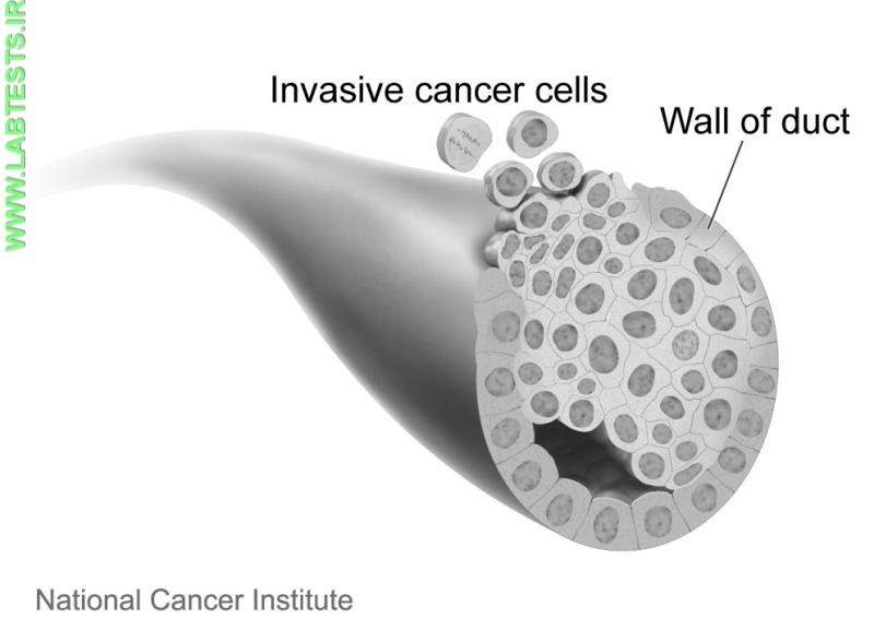 Drawing of invasive breast cancer